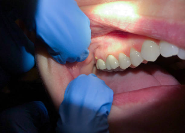 Best Emergency Tooth Extraction in Muse, PA